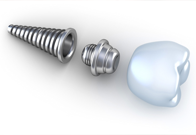 Dental implant