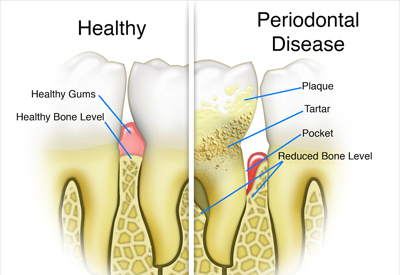 healthy vs periodontitis